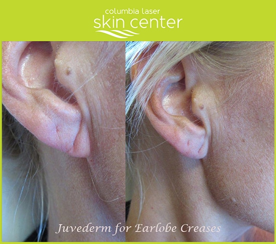Juvederm treatments for earlobes - available for Hood River, The Dalles and surrounding areas in Oregon and Washington at Columbia Laser Skin Centerm Voluma XC