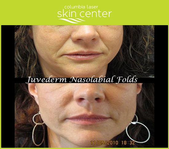 Juvederm Nasolabial Fold Treatment - available for Hood River, The Dalles and surrounding areas in Oregon and Washington at Columbia Laser Skin Center