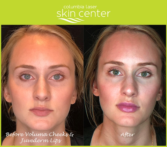 Juvederm XC lip and cheek treatments - available for Hood River, The Dalles and surrounding areas in Oregon and Washington at Columbia Laser Skin Center in Oregon