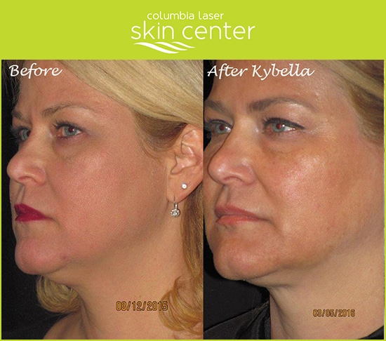 CLSC/Kybella Double Chin repair - available for Hood River, The Dalles and surrounding areas in Oregon and Washington at Columbia Laser Skin Center