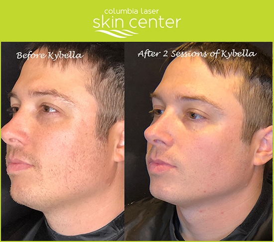 For Men - Kybella Double Chin repair - available for Hood River, The Dalles and surrounding areas in Oregon and Washington at Columbia Laser Skin Center