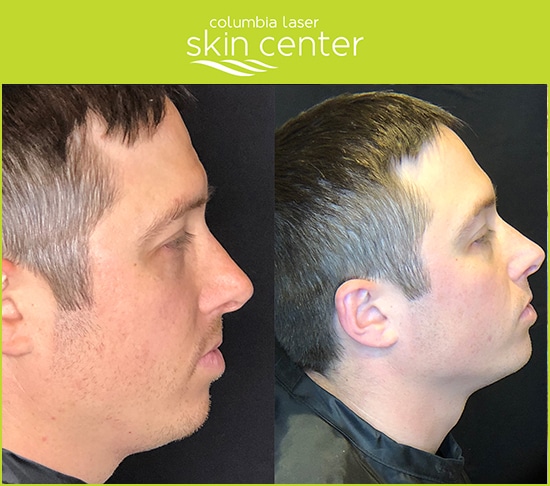 Kybella Double Chin repair for men and women - available for Hood River, The Dalles and surrounding areas in Oregon and Washington at Columbia Laser Skin Center