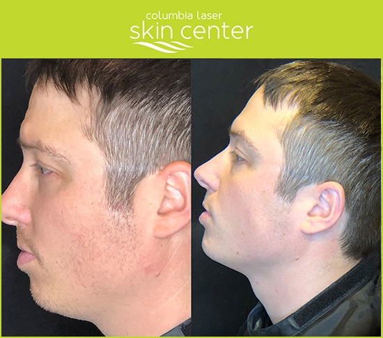 Kybella Double Chin repair for men - available for Hood River, The Dalles and surrounding areas in Oregon and Washington at Columbia Laser Skin Center