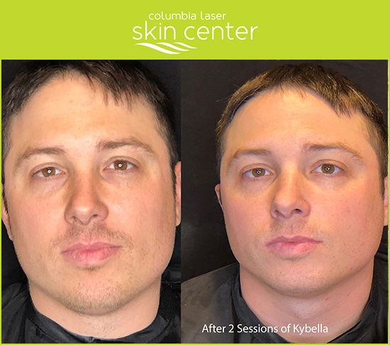 Kybella for Men - Double Chin repair - available for Hood River, The Dalles and surrounding areas in Oregon and Washington at Columbia Laser Skin Center