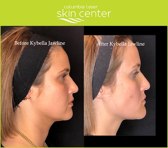 CLSC - kybella for the jawline - available for Hood River, The Dalles and surrounding areas in Oregon and Washington at Columbia Laser Skin Center