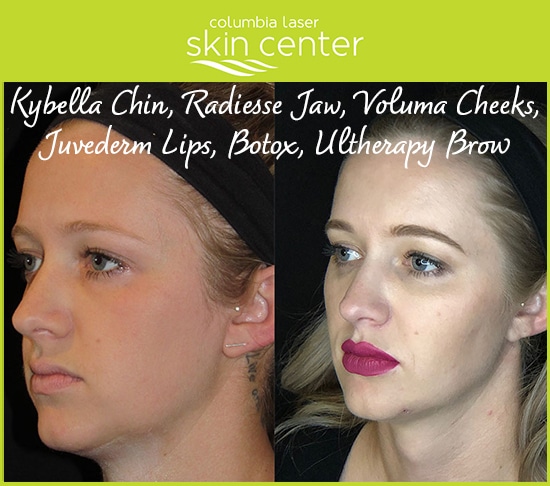kybella chin, radiess jaw, voluma cheeks, juvederm lips, botox, ultherapy brow treatments - available for Hood River, The Dalles and surrounding areas in Oregon and Washington at Columbia Laser Skin Center