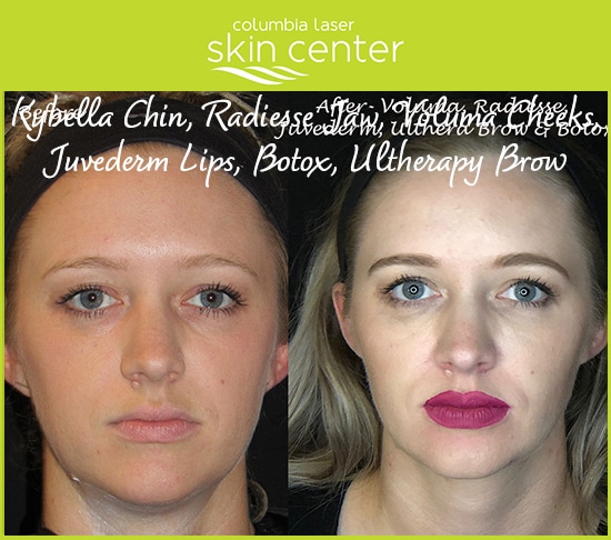 CLSC - kybella chin, radiess jaw, voluma cheeks, juvederm lips, botox, ultherapy brow treatments - available for Hood River, The Dalles and surrounding areas in Oregon and Washington at Columbia Laser Skin Center