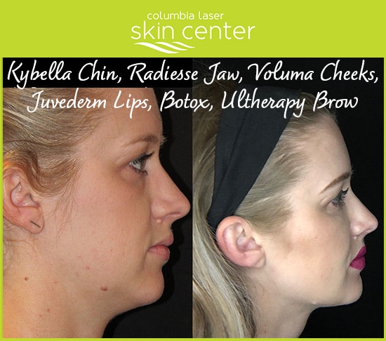 Treatments for kybella chin, radiess jaw, voluma cheeks, juvederm lips, botox, ultherapy brow treatments - available for Hood River, The Dalles and surrounding areas in Oregon and Washington at Columbia Laser Skin Center