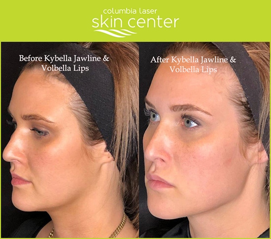kybella and Volbella for the lips and jawline - available for Hood River, The Dalles and surrounding areas in Oregon and Washington at Columbia Laser Skin Center
