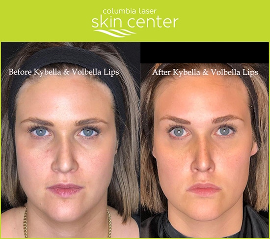 Kybella and Volbella for Lips - available for Hood River, The Dalles and surrounding areas in Oregon and Washington at Columbia Laser Skin Center