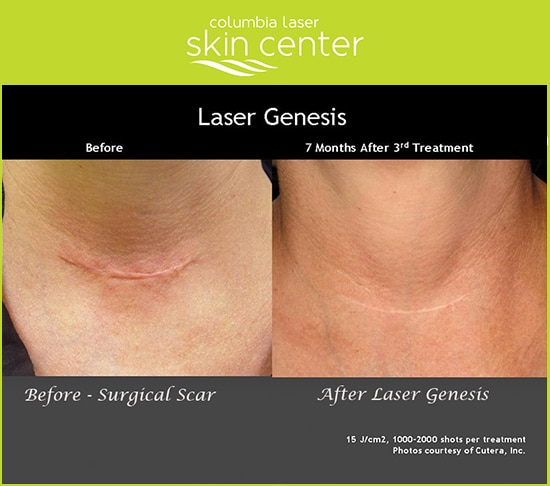 Laser Genesis scar treatment - available for Hood River, The Dalles and surrounding areas in Oregon and Washington at Columbia Laser Skin Center