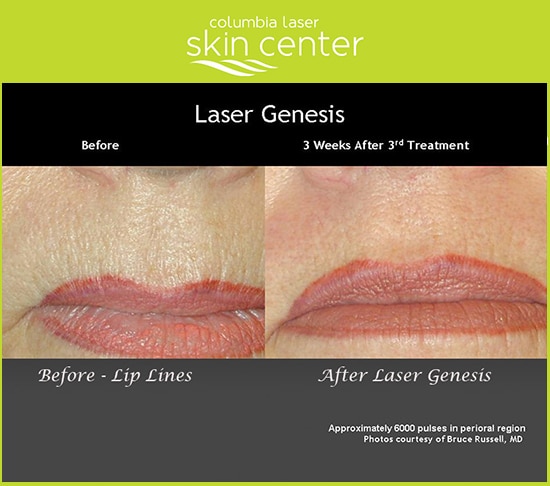 Laser Genesis wrinkle treatment around the lips - available for Hood River, The Dalles and surrounding areas in Oregon and Washington at Columbia Laser Skin Center