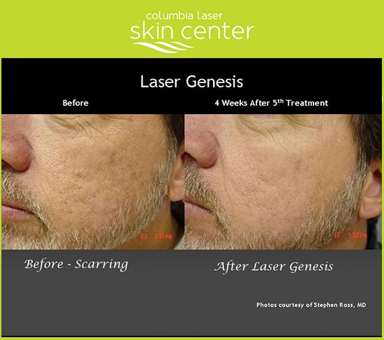 Laser Genesis facial skin treatment - available for Hood River, The Dalles and surrounding areas in Oregon and Washington at Columbia Laser Skin Center
