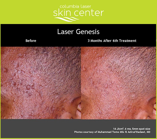 Laser Genesis - available for Hood River, The Dalles and surrounding areas in Oregon and Washington at Columbia Laser Skin Center