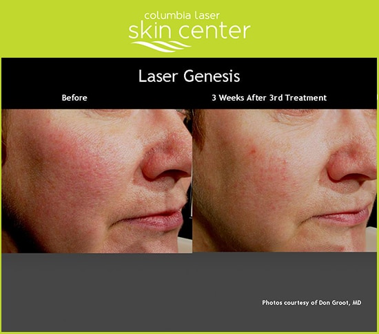 Laser Genesis facial skin treatment - available for Hood River, The Dalles and surrounding areas in Oregon and Washington at Columbia Laser Skin Center