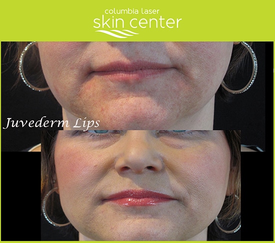 Juvederm Lips - before and after shots
