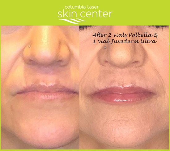 before and after lip treatment - available for Hood River, The Dalles and surrounding areas in Oregon and Washington at Columbia Laser Skin Center