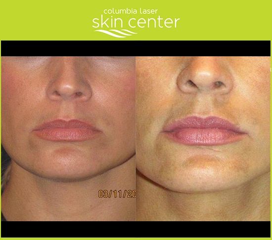 CLSC - before and after lip treatment - available for Hood River, The Dalles and surrounding areas in Oregon and Washington at Columbia Laser Skin Center