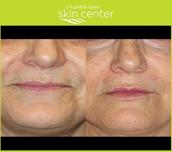 before and after lip treatment - available for Hood River, The Dalles and surrounding areas in Oregon and Washington at Columbia Laser Skin Center