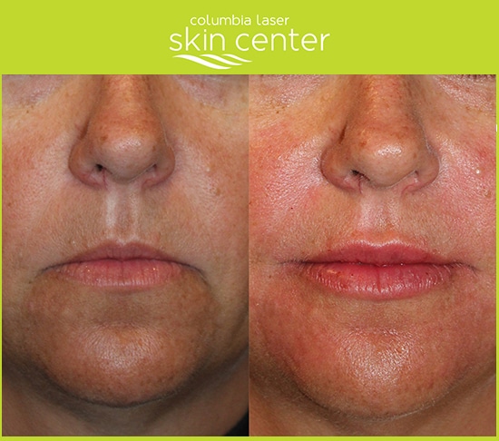 before and after lip photos- available for Hood River, The Dalles and surrounding areas in Oregon and Washington at Columbia Laser Skin Center