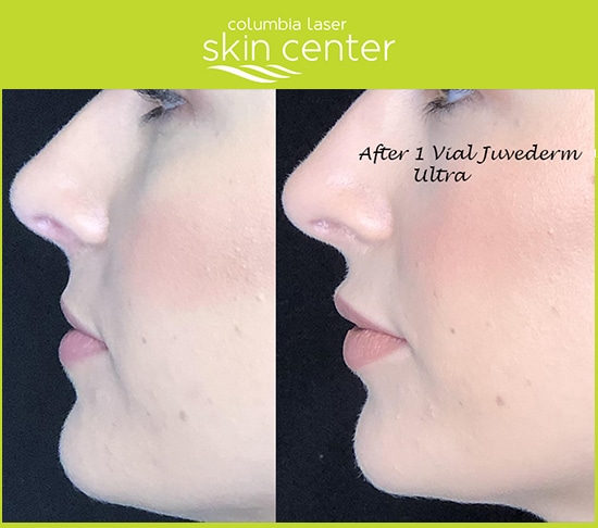 Juvederm before and after lip treatment - available for Hood River, The Dalles and surrounding areas in Oregon and Washington at Columbia Laser Skin Center