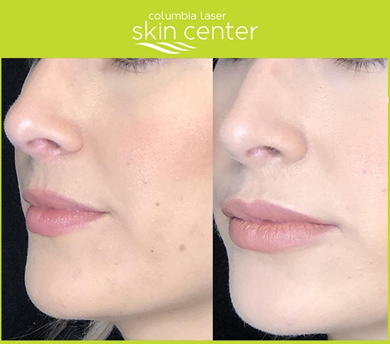 Juvederm before and after lip treatment - available for Hood River, The Dalles and surrounding areas in Oregon and Washington at Columbia Laser Skin Center