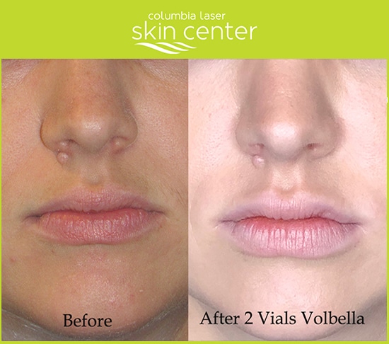 Before and After using 2 vials of Volbella at Columbia Laser Skin Center