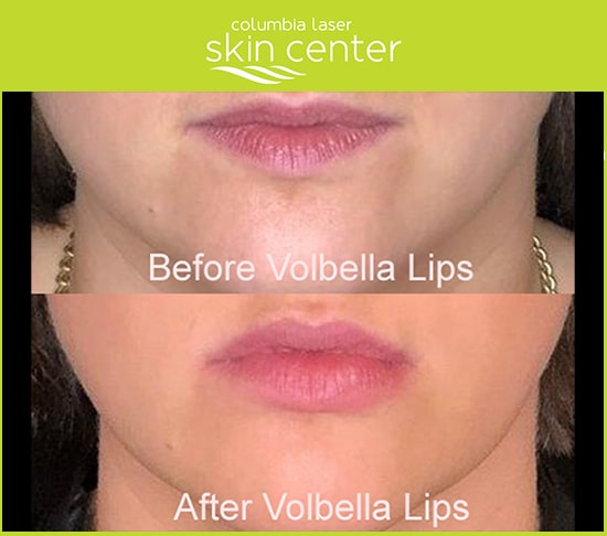 Volbella Lip Treatments before and after