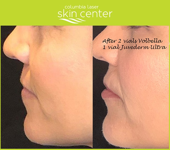 ll and Juvederm treatments - before and after photos