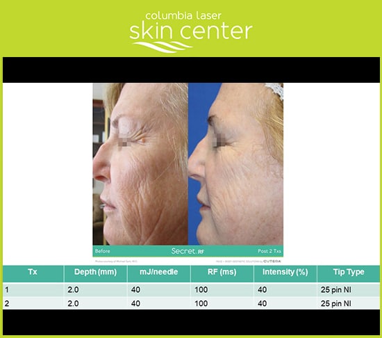 CLSC Secret RF Microneedling - available for Hood River, The Dalles and surrounding areas in Oregon and Washington at Columbia Laser Skin Center
