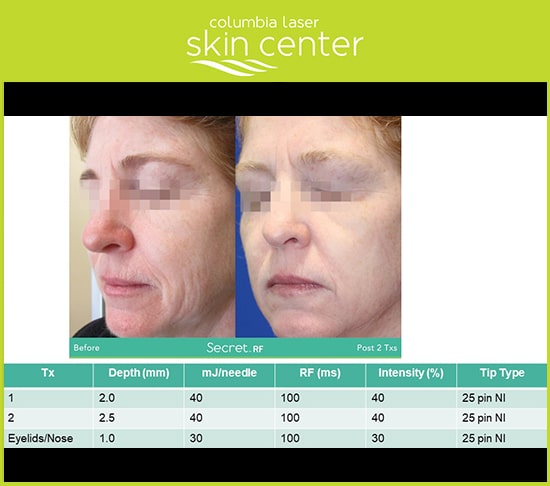 CLSC microneedling before and after - available for Hood River, The Dalles and surrounding areas in Oregon and Washington at Columbia Laser Skin Center