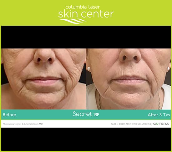 Columbia Laser Secret RF Microneedling wrinkle repair - available for Hood River, The Dalles and surrounding areas in Oregon and Washington at Columbia Laser Skin Center