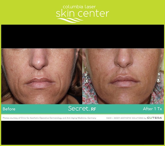 Before and After photos of Secret RF Microneedling wrinkle repair - available for Hood River, The Dalles and surrounding areas in Oregon and Washington at Columbia Laser Skin Center