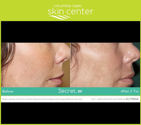 Before/After shots of Secret RF Microneedling wrinkle repair - available for Hood River, The Dalles and surrounding areas in Oregon and Washington at Columbia Laser Skin Center