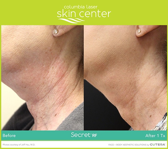 CLSC Microneedling neck repair - available for Hood River, The Dalles and surrounding areas in Oregon and Washington at Columbia Laser Skin Center