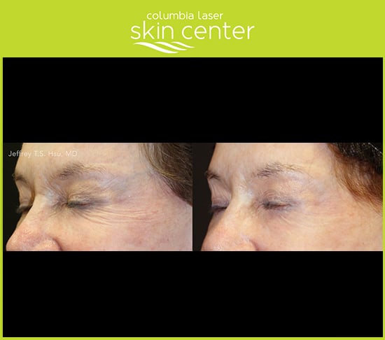 microneedling wrinkle reduction - available for Hood River, The Dalles and surrounding areas in Oregon and Washington at Columbia Laser Skin Center