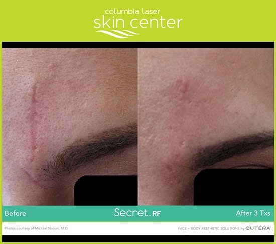 Scar Repair Treatments - Secret RF Microneedling scar repair - available for Hood River, The Dalles and surrounding areas in Oregon and Washington at Columbia Laser Skin Center