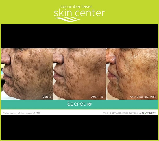 Secret RF Microneedling skin discoloration treatment - available for Hood River, The Dalles and surrounding areas in Oregon and Washington at Columbia Laser Skin Center