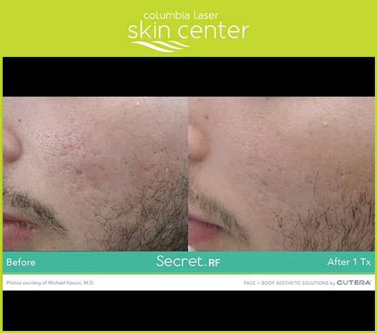 For Acne - Secret RF Microneedling acne scar repair - available for Hood River, The Dalles and surrounding areas in Oregon and Washington at Columbia Laser Skin Center