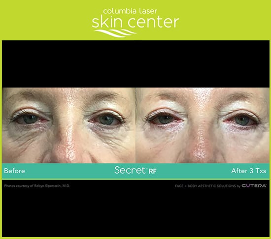 CLSC microneedling wrinkle reduction - available for Hood River, The Dalles and surrounding areas in Oregon and Washington at Columbia Laser Skin Center