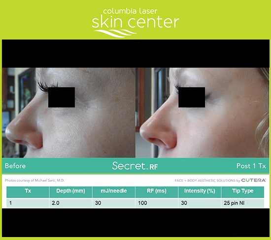 CLSC Secret RF Microneedling - available for Hood River, The Dalles and surrounding areas in Oregon and Washington at Columbia Laser Skin Center