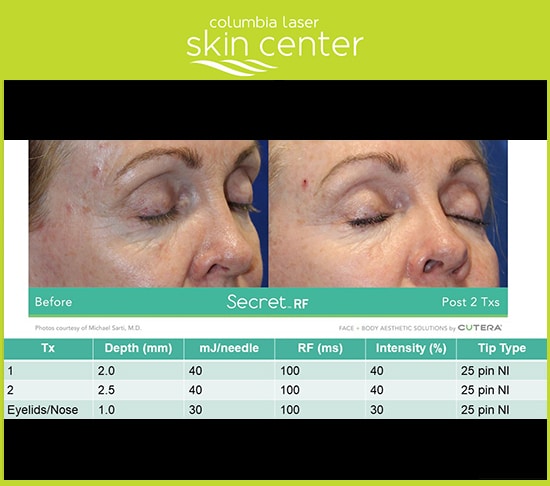 Secret RF Microneedling at CLSC - available for Hood River, The Dalles and surrounding areas in Oregon and Washington at Columbia Laser Skin Center
