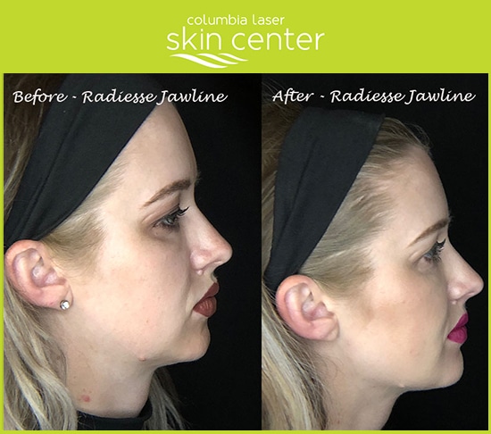 Radiesse Jawline treatment - available for Hood River, The Dalles and surrounding areas in Oregon and Washington at Columbia Laser Skin Center
