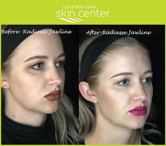 CLSC Radiesse Jawline treatment - available for Hood River, The Dalles and surrounding areas in Oregon and Washington at Columbia Laser Skin Center