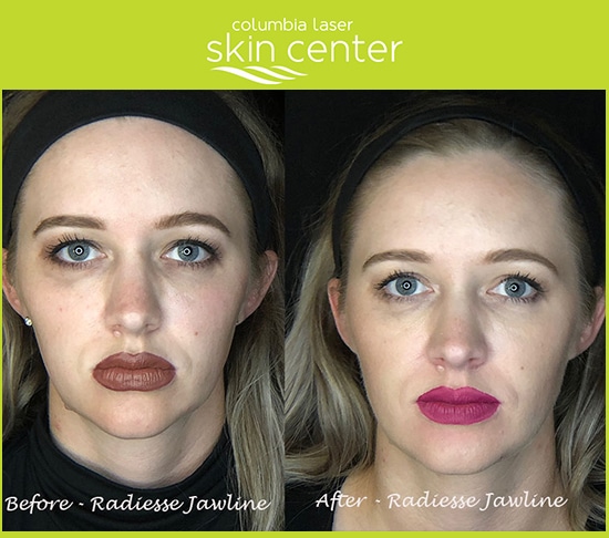Radiesse Jawline before and after- available for Hood River, The Dalles and surrounding areas in Oregon and Washington at Columbia Laser Skin Center