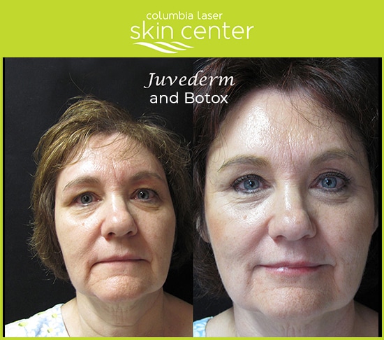 Before and After - Juvederm and botox facial treatments - available for Hood River, The Dalles and surrounding areas in Oregon and Washington at Columbia Laser Skin Center
