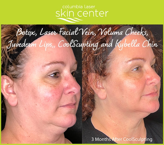 Before and After - Total Transformations aesthetic treatments - available for Hood River, The Dalles and surrounding areas in Oregon and Washington at Columbia Laser Skin Center