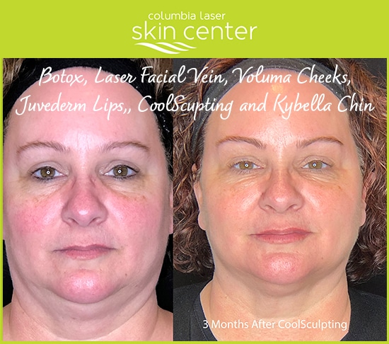Before and After botox, laser, voluma cheeks, juvederm lips, coolsculpting and kybella chin treatments - available for Hood River, The Dalles and surrounding areas in Oregon and Washington at Columbia Laser Skin Center