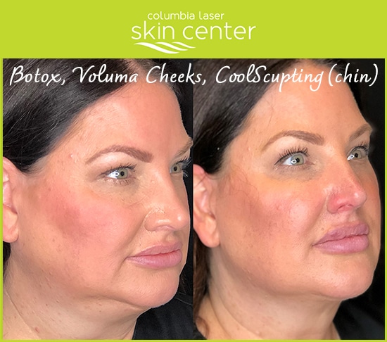 CLSC- botox, laser, voluma cheeks, coolsculpting and kybella chin treatments - available for Hood River, The Dalles and surrounding areas in Oregon and Washington at Columbia Laser Skin Center