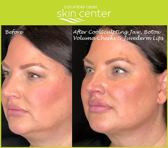 Total Transformation before and afters aesthetic treatments - available for Hood River, The Dalles and surrounding areas in Oregon and Washington at Columbia Laser Skin Center